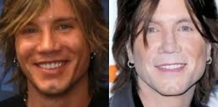 John Rzeznik's before and after of plastic surgery.
